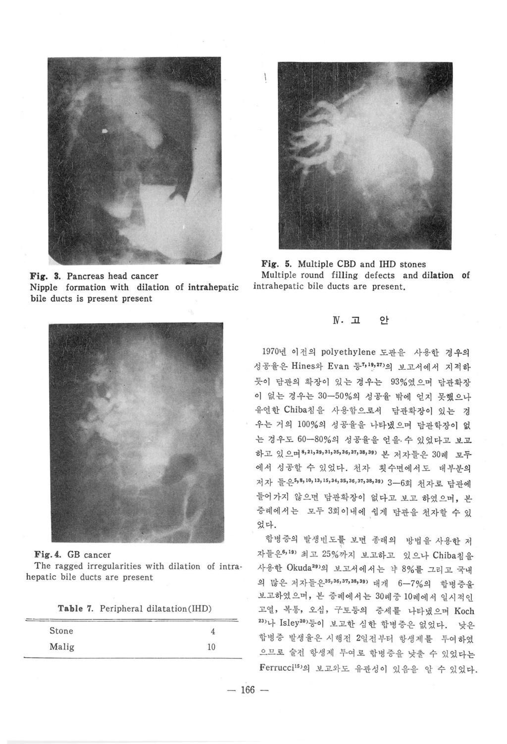 Fig. 3. Pancreas head cancer Nipple foration with dilation of intrahepatic bile ducts is present present Fig. 5.