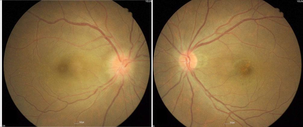 - 김원제외 : 시신경염과맥락망막염으로나타난눈매독 - Figure 2. The fundus photography of both eyes when the patient reported a new deterioration of vision in the right eye.
