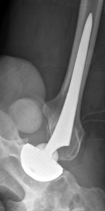 Radiologic Results of Enrolled Patients Radiologic result Proximal femur morphology* Value Type A 42 Type B 56 Type C 4 Femoral component Stem position Neutral position 86 (84.