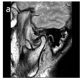 On MRI view, joint space of rt TMJ was expanded with soft tissue mass lesion.