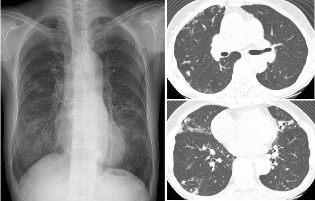M. intracellulare pulmonary disease of the nodular bronchiectatic form in a 67 year old woman. Chest radiograph shows a multifocal patchy distribution of small nodular clusters in both lungs.