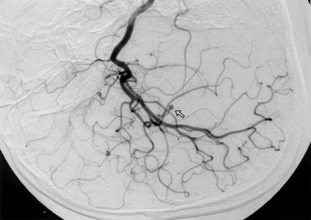 lenticulostriate artery 등 M1의 가지들이 기원하 segment는 피질가지(cortical branch) 들로 이루어 진다. 는 부위다(10~15%).
