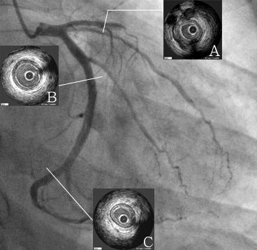 - 대한내과학회지 : 제 73 권제 3 호통권제 565 호 2007 - Figure 4. A coronary angiogram (CAG) from case 2. The diagnoistic CAG shows total occlusion on the proximal left anterior descending coronary artery.
