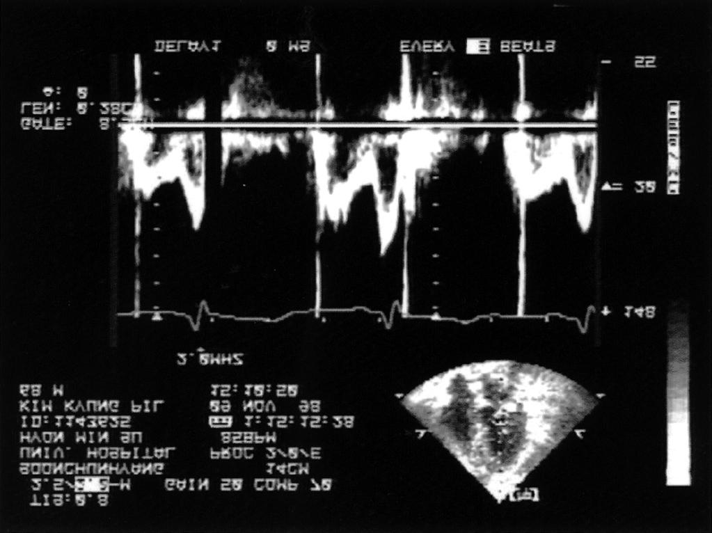 Pulsed Doppler echocardiography at tips of mitral leaflets shows respiratory variation on E wave peak velocity. 의 혈전을 제거한 후, 심장을 들어 좌심실 obtuse marginal branch 영역에서 심실의 수축에 따른 혈액의 누 출부위가 확인되었다.