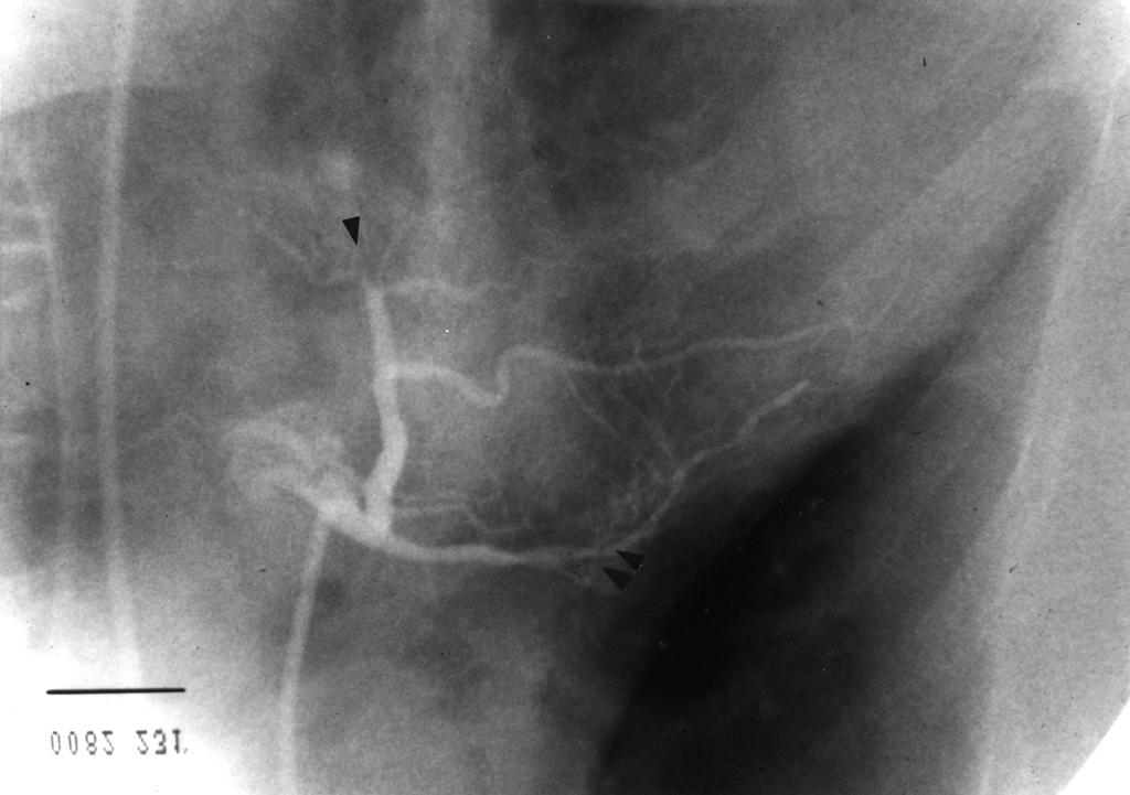Right anterior oblique view of left coronary angiogram showed that distal left circumflex artery is totally occluded (infarct related artery, single arrow head) and multiple stenotic lesion of left