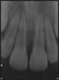 And the ffected tooth ws positioned ucclly(). Fig. 14, 14.