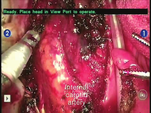 Pulsation of carotid artery was identified easily in magnified 3-dimension images and surgeon can prevented injury of it. 있었다 (Fig. 5). 동결절편검사를이용해수술부위절제연의악성종양유무를확인하고음성으로보고되어더이상의추가적인절제는시행하지않았다.