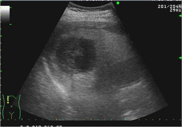 Geum-Ha Kim, et al. case of primary hepatic epithelioid hemangioendothelioma with spontaneous rupture Figure 1. Ultrasonographic images of the right hepatic lobe.