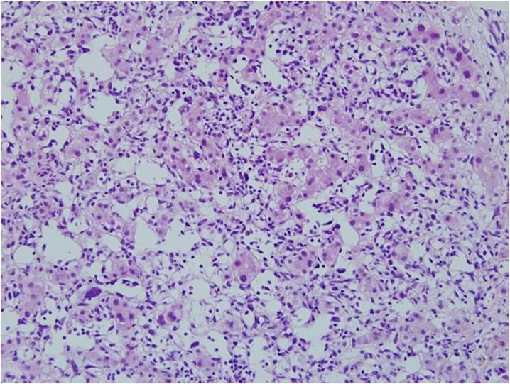 () On delayed phase imaging, the mass exhibits delayed centripetal enhancement. Figure 3. Microscopic findings of a hepatic epithelioid hemangioendothelioma.