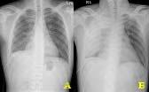 (A) After pigtail catheter insertion, pleural effusion was decreased yet elevated diaphragm due to loculated pleural effusion was remained.