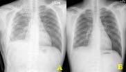 Tuberculosis and Respiratory Diseases Vol. 57. No. 5, Nov, 2004 Figure 3. (A) After hematoma removal and decortica tion, lung was expanded fully and there was no blunting of costophrenic angle.
