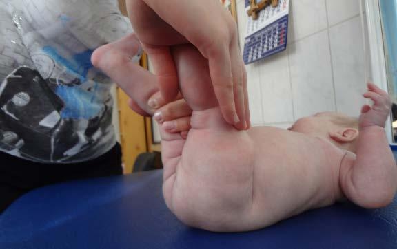 poziționat în ghemuit: copilul nu-și susține greutatea picioarele se poziționează asimetric, iar la mișcările în lateral induse de terapeut, nu apare inversia-eversia normală (Metayer) (Fig.