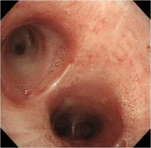 showed no endobronchial lesion (Upper: left upper lobar bronchus, Lower: left lower lobar bronchus).