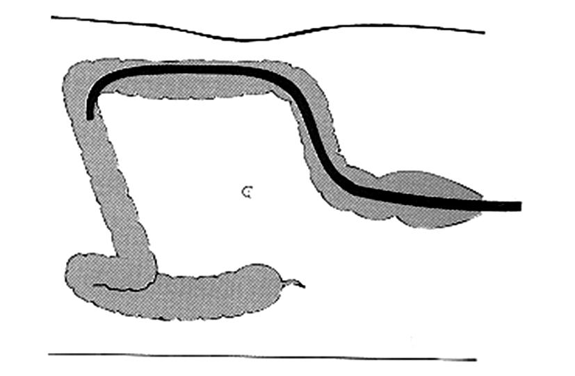Figure 2. (A) In the left lateral position, the transverse colon flops down making the splenic flexure acute.