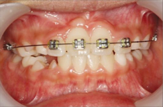 upper centrl incisor. Fig. 6.