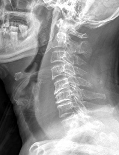 3 mm, retrotracheal space at C6: 53.9 mm) without fracture/dislocation from C1 to thoracic area.