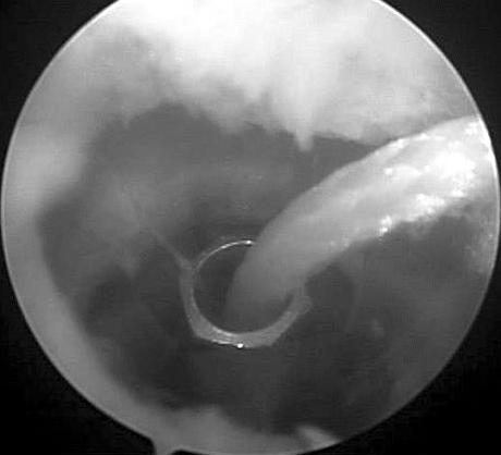 전재균외 : 청소년에서성장판손상을최소화하는전방십자인대복원술 183 Fig. 3. Pull on the distal Fiberstick suture until the screw is vertical, then push the drive tip into the screw cannulation.