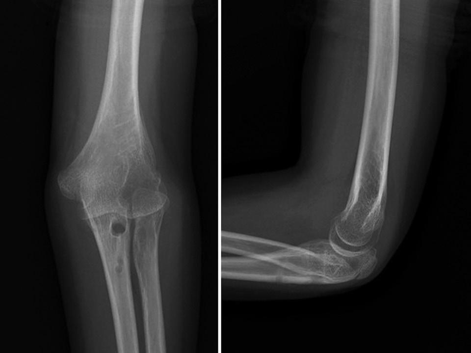 Sang Ho Kwak, et al. Recurrent Posterior Dislocation of the Elbow 주관절의전방관절막에있던이소성골은제거하였는데구상돌기골절편이따로관찰되지않은것으로보아구상돌기골절편이관절낭에부착하여자란것으로생각된다.