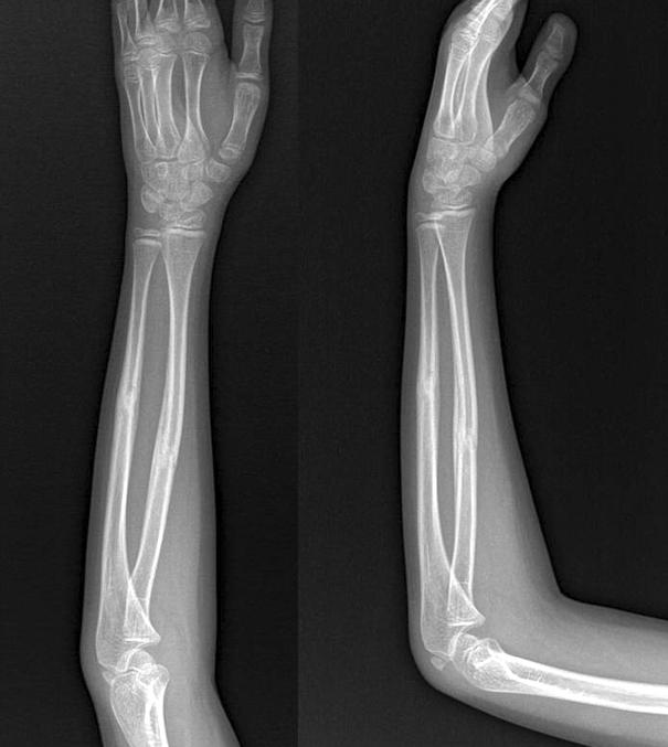 336 주선영, 김현우 은추시가요구된다 (Fig. 2). 2. 골수내고정술 골수내고정술은 K- 강선또는유연성골수정 (flexible intramedullary nail) 을이용하여고정하는것으로 19