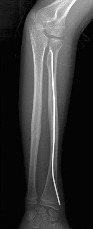 (A) Initial radiograph of a 12-year-old boy with a closed fracture