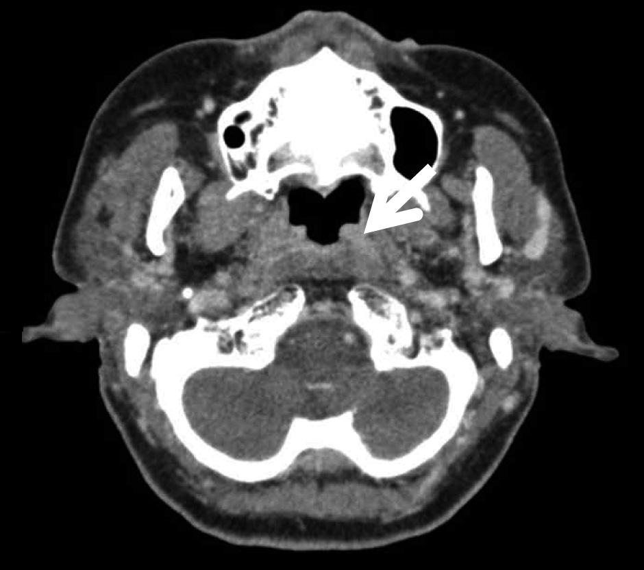 MLT was shown in nasopharynx tissue, with germinal center