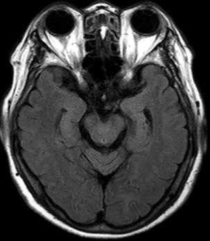 검사소견 1) Laboratory(X년 7월 11일 ) : Unremarkable 2) Brain magnetic resonance imaging(x년 7월 11일 ) : Unremarkable Fig. 1. Brain MRI & MRA. 11. 계통적문진 1) 睡眠 : 양호 2) 食事 / 消化 : 양호 3) 寒熱 : 顔面熱感 4) 頭 : 頭頂痛 5) 面 : 顴紅 6) 舌 : 舌淡紅黃苔 7) 脈 : 數 8) 大便 : 1회 /1일, 양호 9) 小便 : 양호 12.