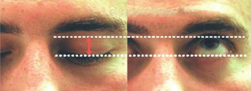 Measurement of the palpebral fissure and margin reflex distance (From Neurology-Ophthalmology Illustrated). Levator function (14 mm) 해서도 주의 깊게 관찰한다.