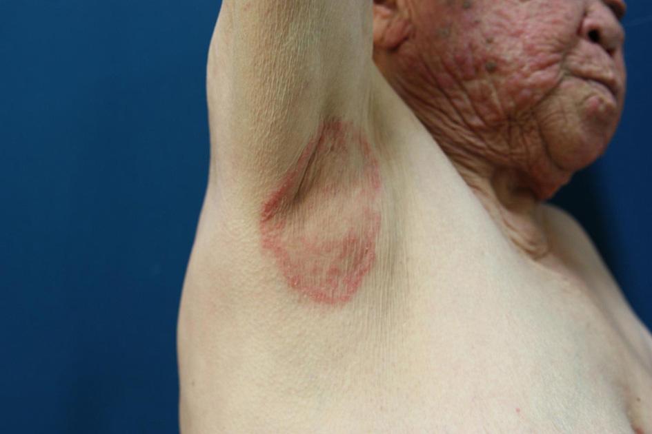 (A) well-dermacated erythema on the axilla (B) a large