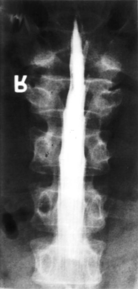 유합술을 교적 드물게 보고되고 있으며8) 척추 후관절 부위, 황색 인 시행하였다(Fig. 4).