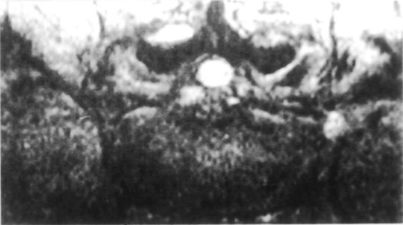 the right L5 root. Fig. 5. Microscopic photograph shows cyst wall which contains dense fibrous tissue.
