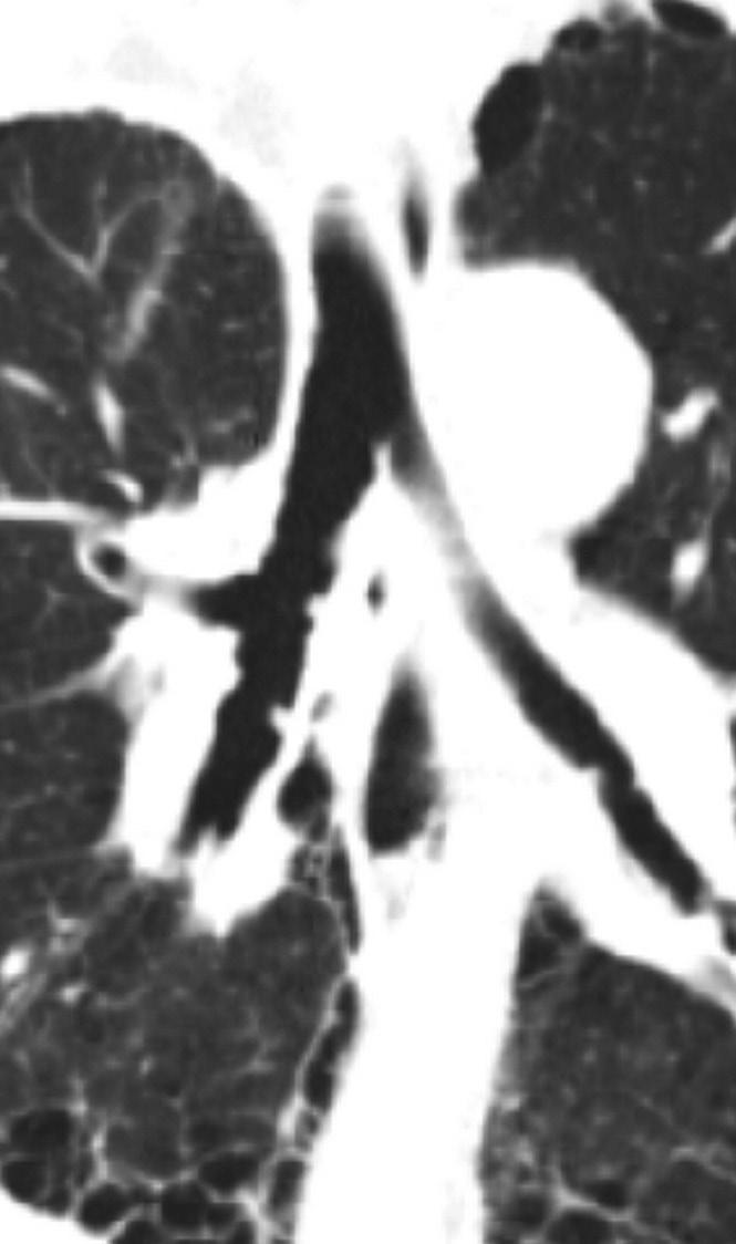 Initial CT without enhancement axial image mediastinal window shows a 2 cm-sized nodule in the left lower lobe, which was confirmed to be
