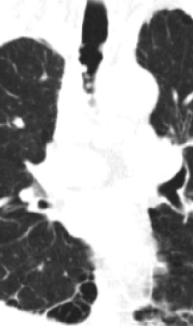 Follow-up CT without enhancement axial and coronal image mediastinal windows obtained two years after wedge resection show a 1.
