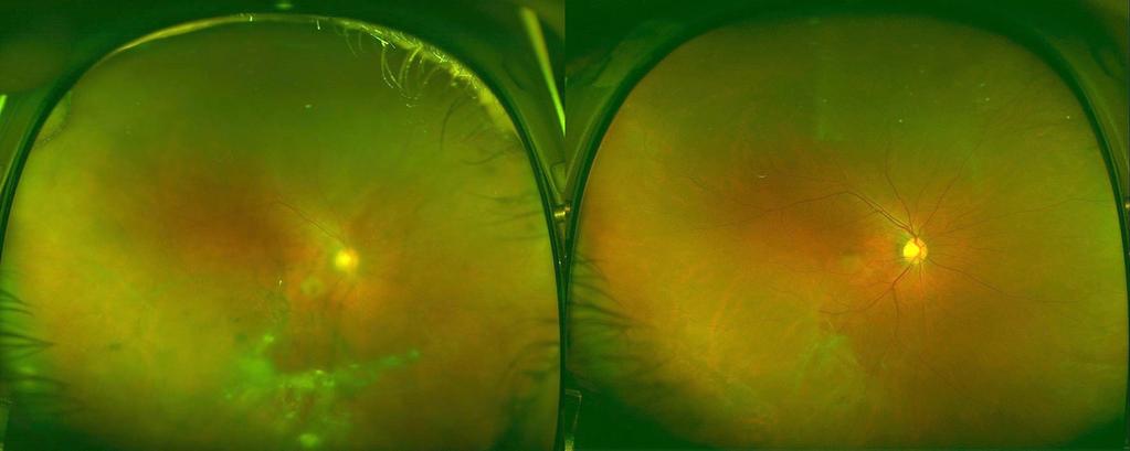 Ultra-wide-field fundus photographic findings of a patient with ocular toxocariasis before and after treatment of oral prednisolone with albendazole.