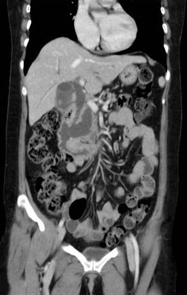 십이지장 샘암종과 동반된 악성 췌관 내 유두상 점액 종양 1예 박경석 외 Figure 1. Arterial phase of abdomino-pelvic computed tomography (CT).