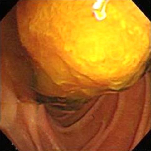 내시 경 및 EUS에서 바터 팽대부 하방 1 cm에 점액으로 덮여 있는 이형 반향 용종(heteroechoic polyp)이 있었으며, 그 내부에는 줄기(stalk)가 동반된 혈관성 구조가 있었다.