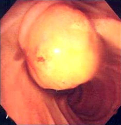 orifice and duodenal mass is located beside the papilla.