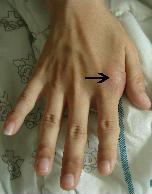 - The Korean Journal of Medicine: Vol. 76, Suppl. 1, 2009 - A B C Figure 1. The patient had large gouty tophi on the dorsum of the right hand (A) and auricle (B).