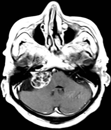 최두용등 A B C Fig. 1. Magnetic resonance images(mri) of a patient with a large vestibular schwannoma before and after surgery. A:A preoperative MRI shows a large(2.7 3.5 3.