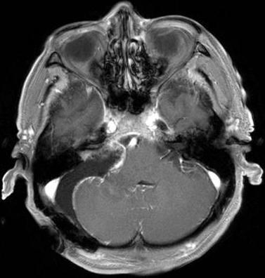 Ipsilateral CP cistern is enlarged, and adjacent cerebellum and pons are displaced and buckled with mild 4th ventricle compression.