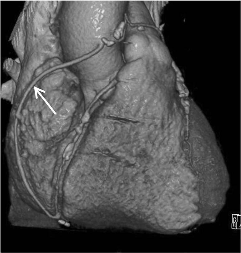 Coronary rtery ypass Graft and MDCT Figure 2. Figure 3.