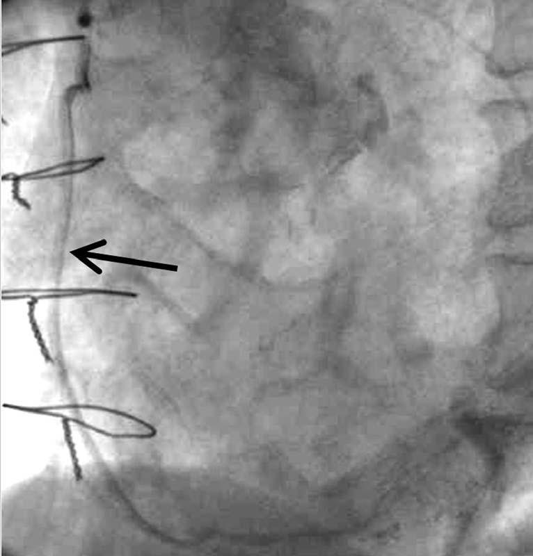 Patent saphenous vein graft from ascending aorta, anastomosed to