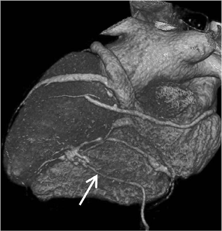 artery is not visualized on MDCT images ( and C).
