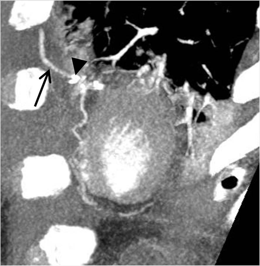 Coronary rtery ypass Graft and MDCT Figure 6. Figure 7.