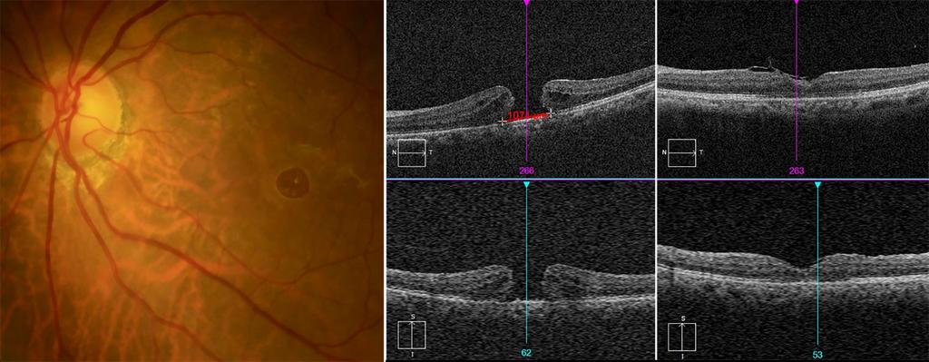 2 months after surgery, type 1 closure of hole was detected in OCT scan image (C). logmar vision improved from 0.80 to 0.70. Figure 7. A case of full thickness macular hole in 70-year-old-female.