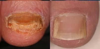 (2005) DSO DLSO SWO SO PSO CO TDO EO *Subtype: Distal type, Lateral type, Multiple type DSO : distal subungual onychomycosis, DLSO : distal lateral subungual onychomycosis SWO : superficial white