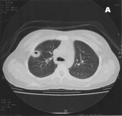 EJ Kim, et al.: Lemierre syndrome Figure. 1. Chest radiograph shows a cavitary lesion in the right upper lung field and two nodular shadows in both middle lung zones.