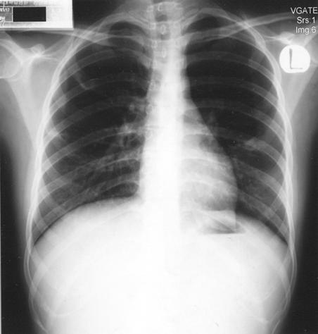 Tuberculosis and Respiratory Diseases Vol. 58. No. 1, Jan, 2005 Figure 3.