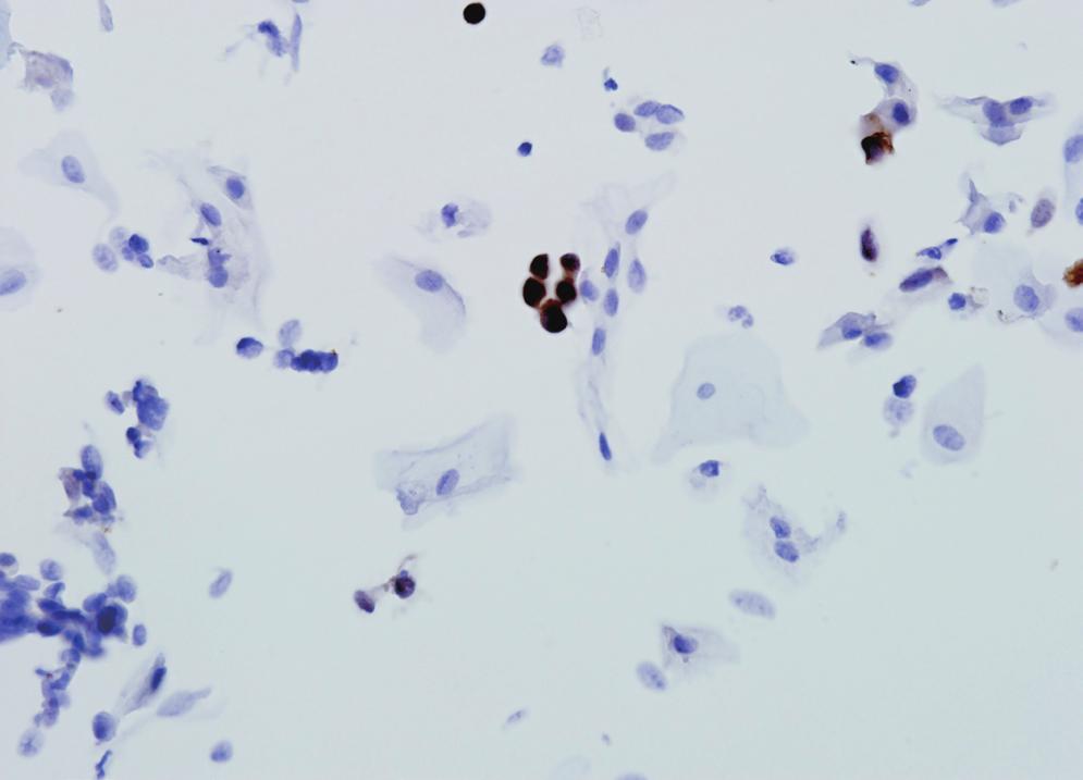 291 p16ink4a Immunocytochemical Staining in ASC-H 본 저자들은 ASC-H로 진단되었던 액상 자궁경부 세포진 검체에 포의 숫자 및 염색의 강도 두 가지를 기준으로 판독하였다.
