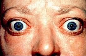 2) Symptomatic Terms exophthalmos 안구돌출증