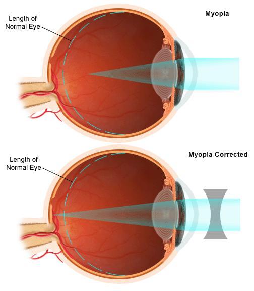 3) Refractive Terms myopia(near sightedness)